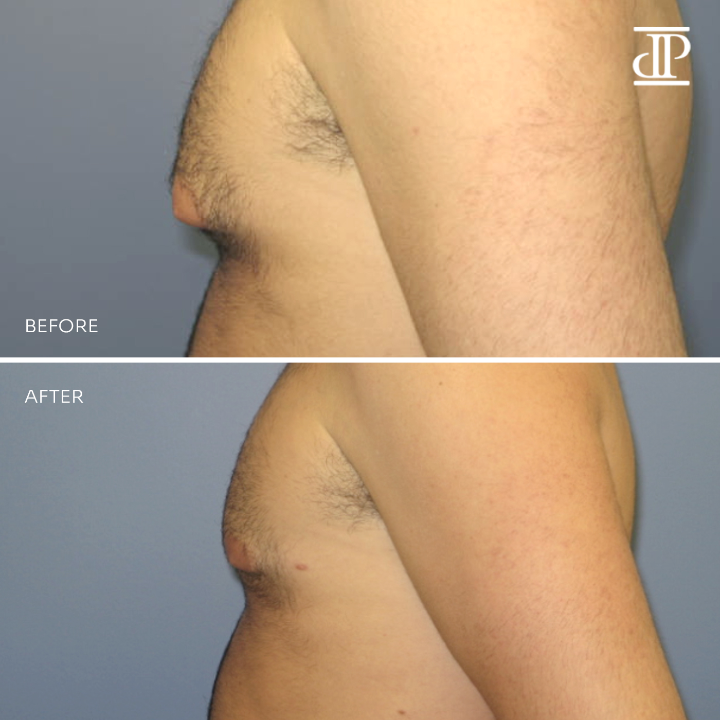 Breast Lift with Reduction West Island, Montreal - Plastic Surgery