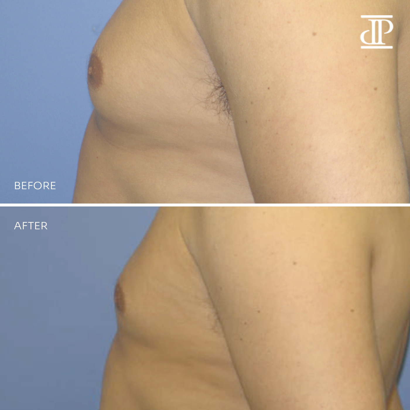 Breast Lift with Reduction West Island, Montreal - Plastic Surgery